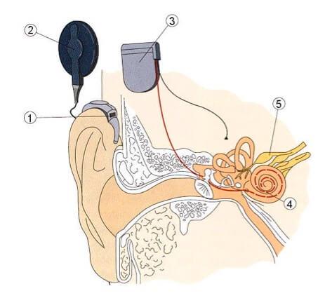 Cochlea-Implantat Skizze
